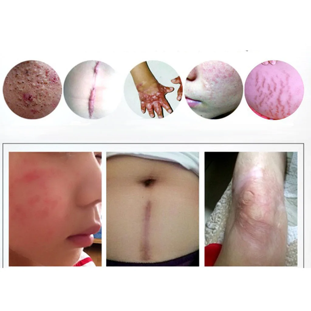 Гель для удаления шрамов от келоидов ожогов спортивных травм акне 30 г