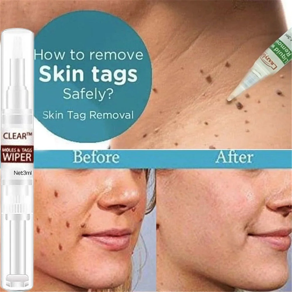 Новинка 3 мл лечение половых органов удаление папилломы бородавок жидкость с