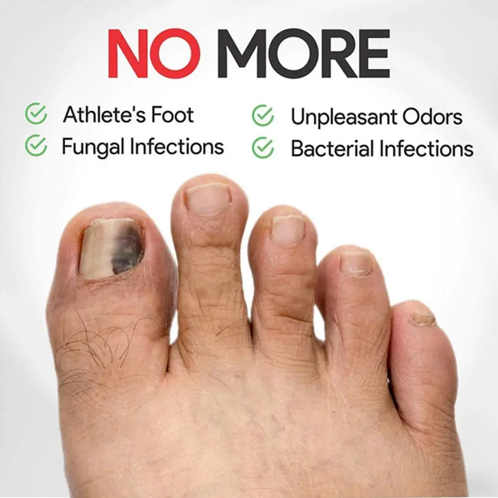 

10ml/30ml Onychomycosis Liquid Hand And Foot Onychomycosis Repair Care And Nail Antibacterial Thickening Treatments R4H0