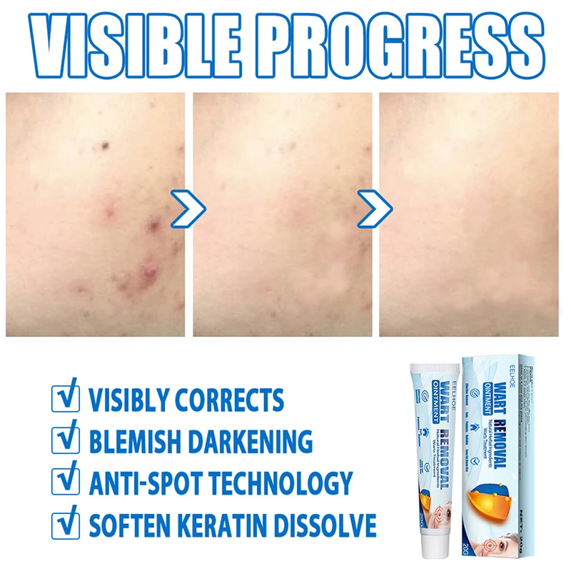 2Pcs Warts Remover Ointment Wart Treatment Cream Skin Tag Herbal | Красота и здоровье