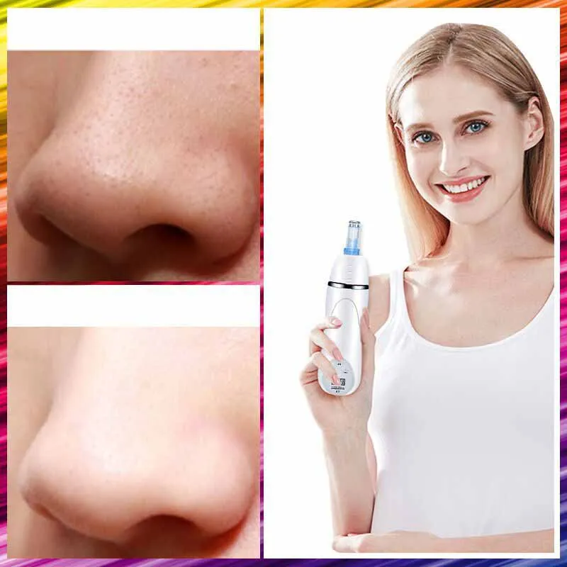 Аппарат Алмазный для микродермабразии удаление черных точек акне дермабразия