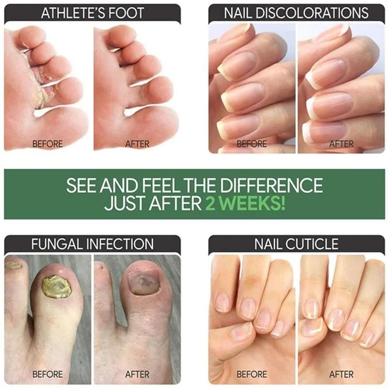 

20ml Nail Treatment Pen Nail Repair Onychomycosis Paronychia Fungal Fungus Care Repair Serum Nail Infection Anti Toe G4E1