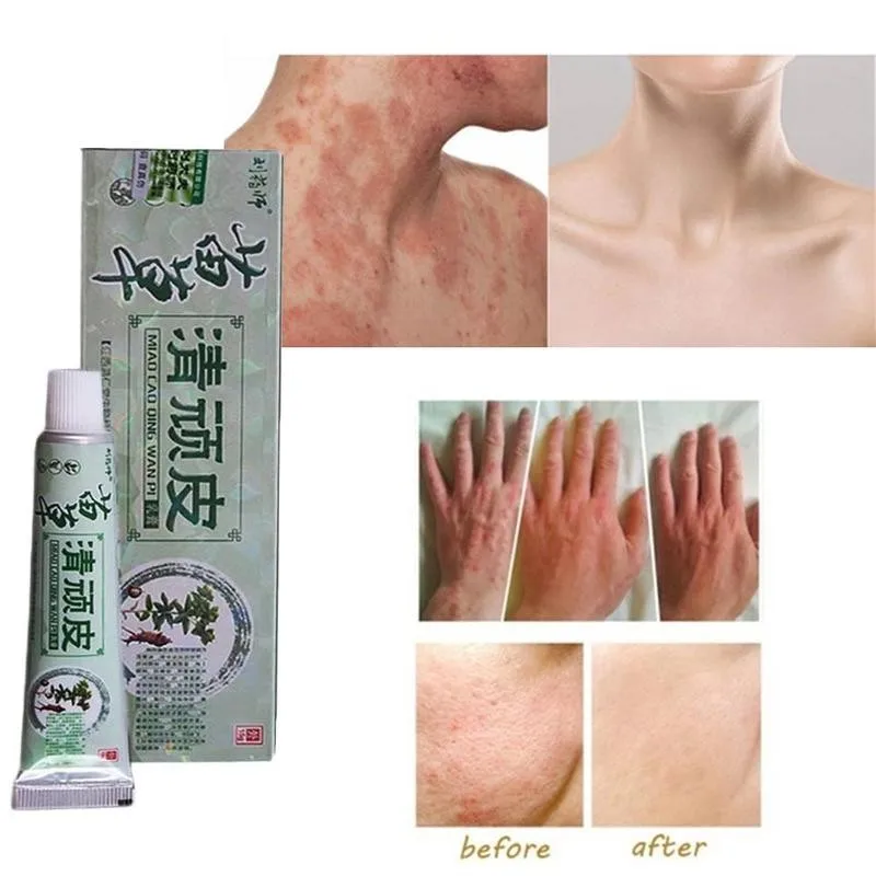 

15g Herbal Body Cream Skin Psoriasis Cream Dermatitis Psoriasis Ointment Treatment Eczematoid Cream Care Skin Eczema Cream Z1L3