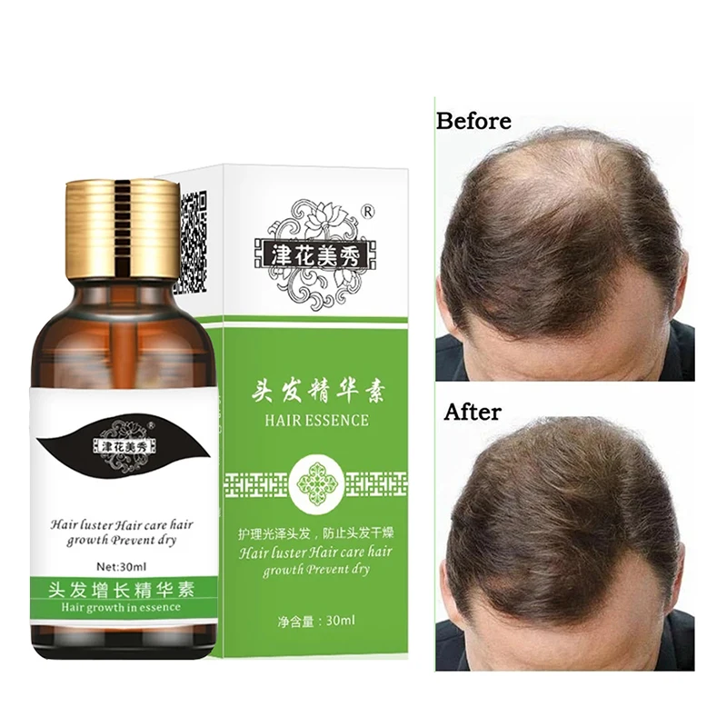 

Fast Hair Growth Essence Hair Loss Products Hair Growth Fibras Cabelo Shampoo Cremes De Tratamento Para Cabelos Hair Care
