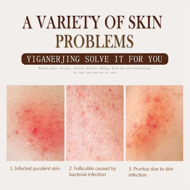 

10 PCS Eczema Ointment Treatment Psoriasis Cream New Skin Herbal Psoriasis Pruritus Cream Dermatitis Eczematoid Skin Care Cream