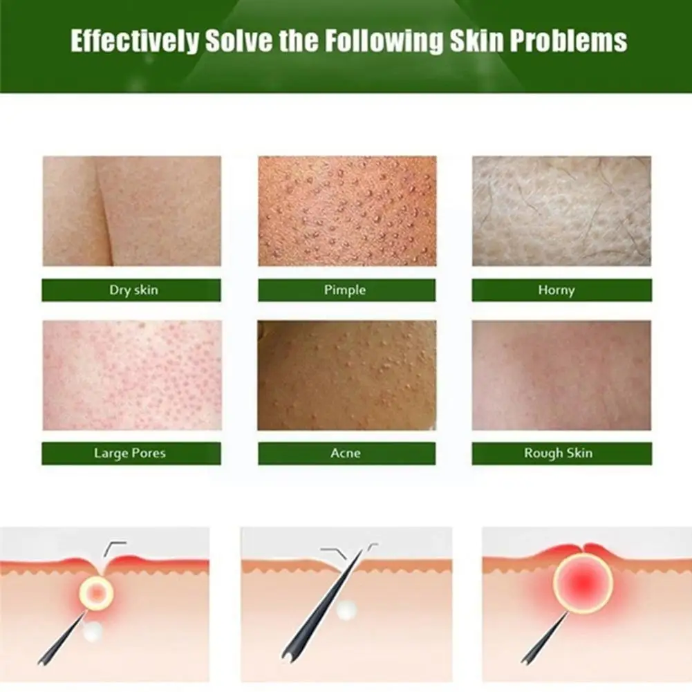 

50g Curing Keratosis Pilaris/ Kp/ Chicken Skin Body Cream Nourishing Skin Skin Lotion Essence Care And Moisturizing Repair W8L7
