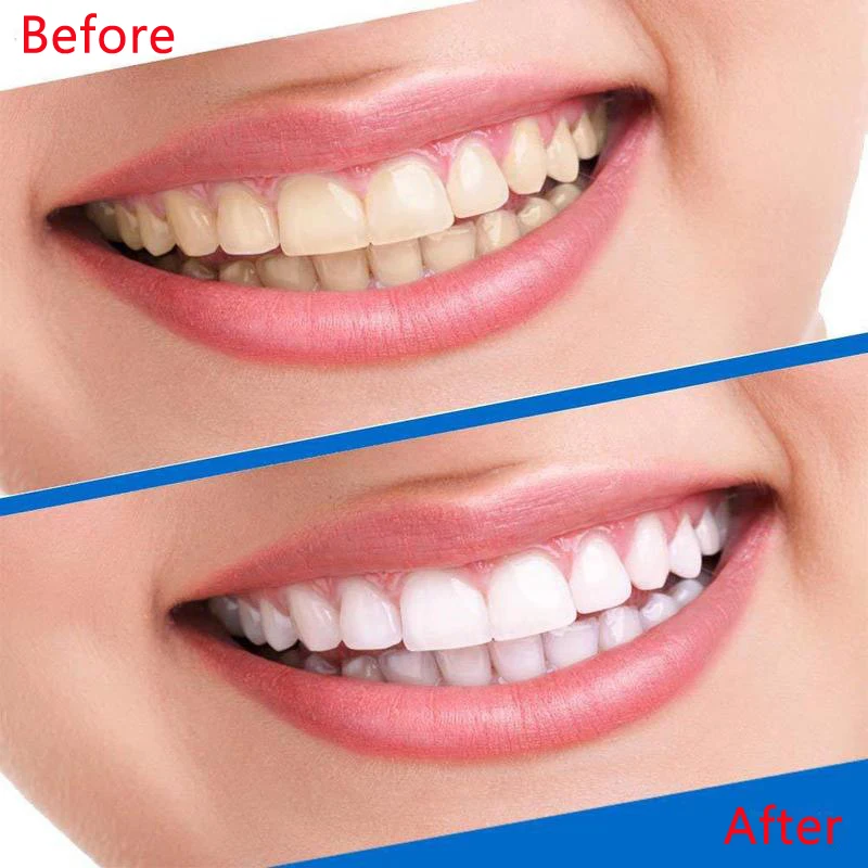 Y-kelin Teeth Whitening Strips White Tooth Dental Kit Oral Hygiene Care Strip False Veneers Dentist Whiten Fake | Красота и здоровье
