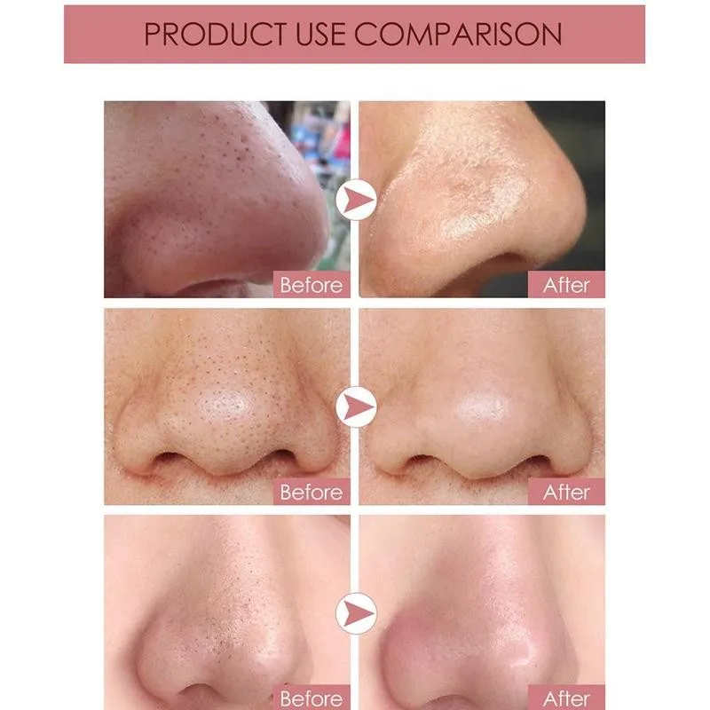 

KIMUSE Blemish Blackhead Remover Blackhead Pimple Nasal Oil Nose Patch Control Patch Clean Cleaning Nasal Pore U9B8