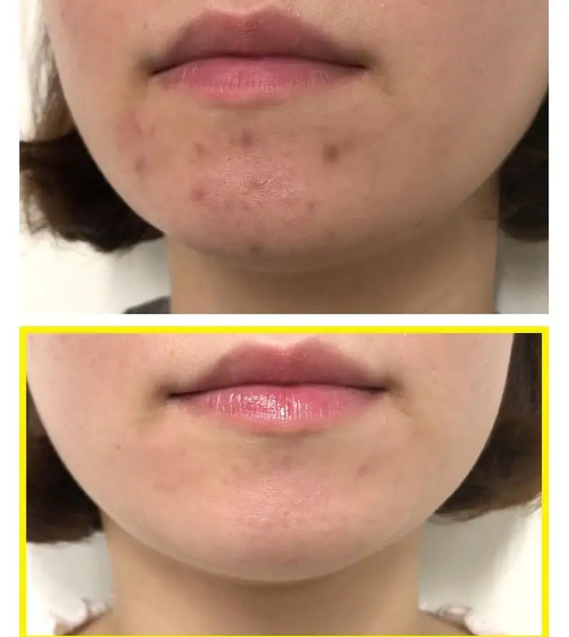 Отшелушивающее средство для удаления черных точек 30 дней | Красота и здоровье