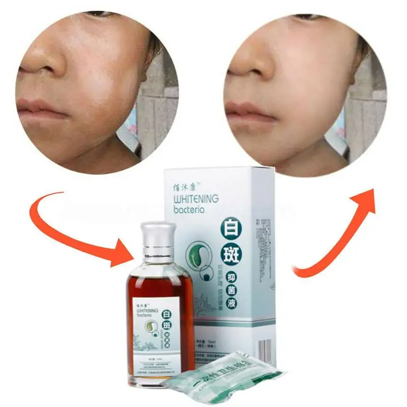 Пигмент для лечения белых пятен жидкий пигмент кожи меланин продвижение линины