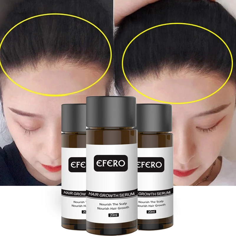 

EFERO 30/20/10pcs Ginger Hair Growth Serum Anti Hair Loss Products Fast Grow Prevent Hair Dry Damaged Thinning Repair Care