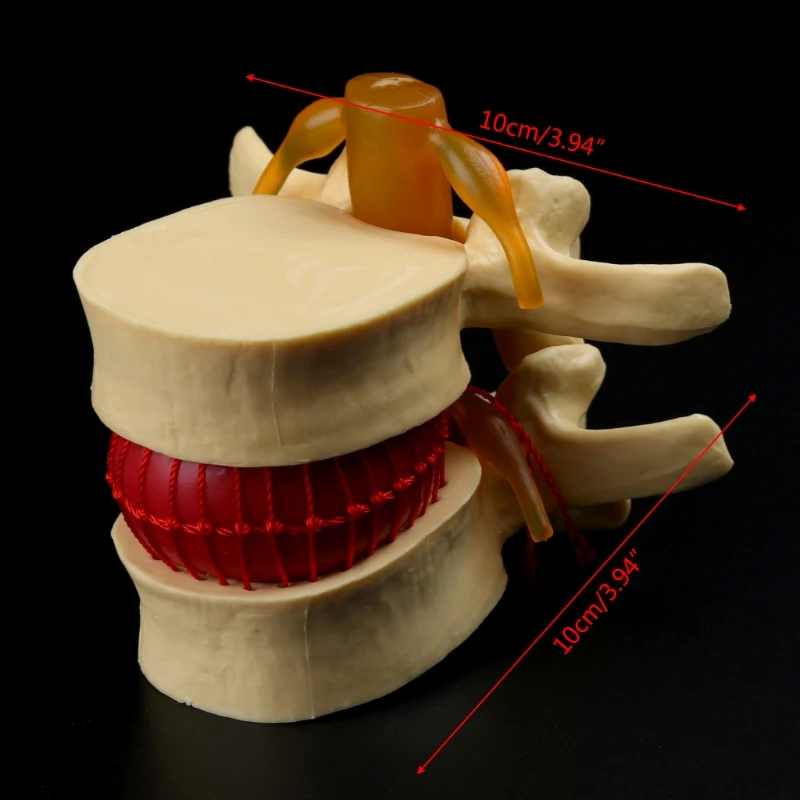 

Medical props model Free postage Anatomical Spine Lumbar Disc Herniation Anatomy Medical Teaching Tool