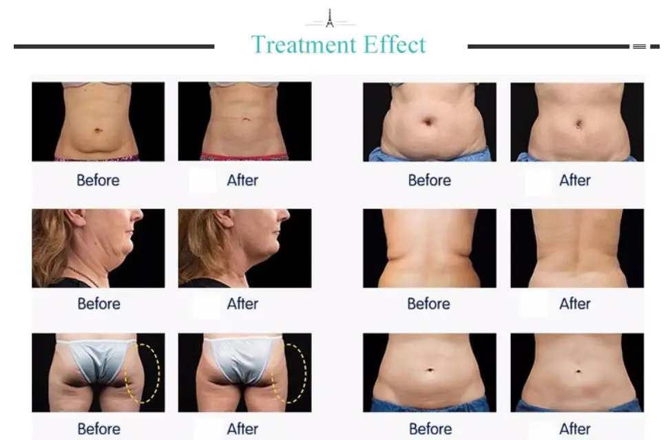 5 в 1 Ультразвуковая Липосакция 80K кавитационный вакуумный многополярный