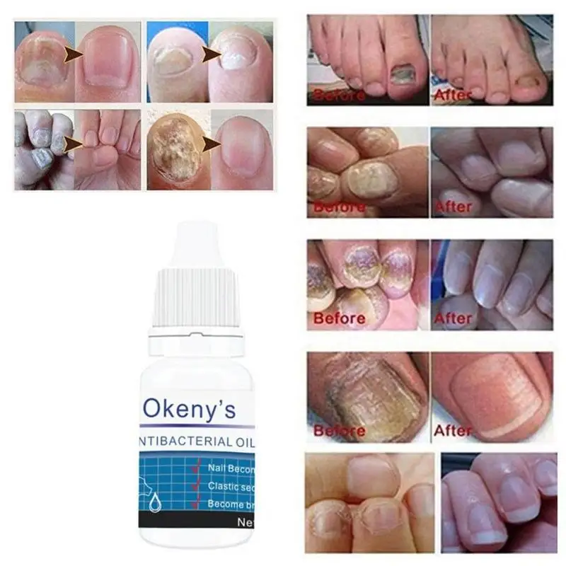 

5ml Fungal Nail Treatment Nail Fungus Repair Anti Fungal Onychomycosis Toe Removal Liquid Treatment Nail N9D4