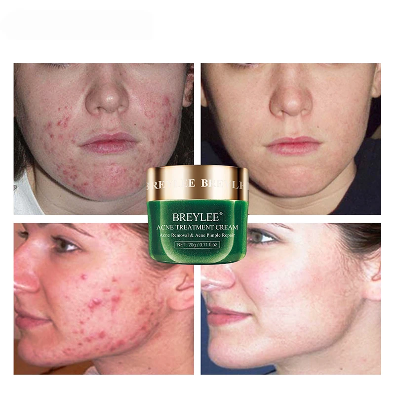 

Acne Treatment Cream Anti Acne Face Cream Remove Acne, Control Oil, Calm The Skin Face Care Products