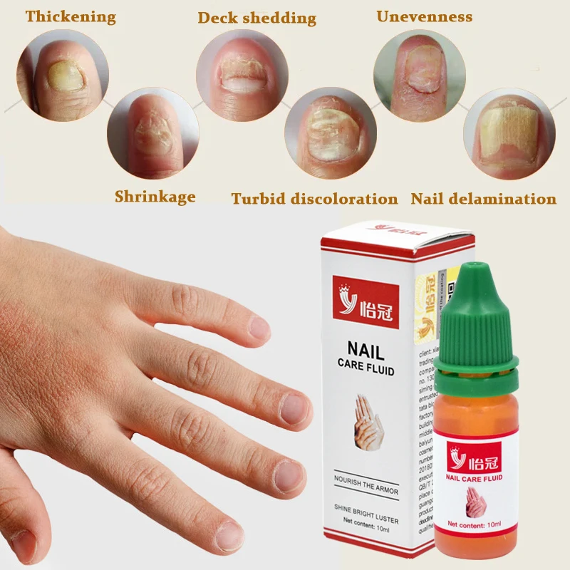 

Chinese Medicine Herbs Toe Nail Fungus Treatment Anti Fungal Nail Infection Essence Nail Removal Nail Care Lotion Plaster