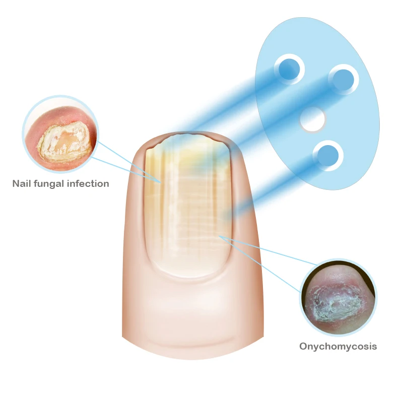 Home use laser for nail fungus treatment Cure Fungus Onychomycosis Painless Therapy Treatment For Toes And Fingernails | Красота и