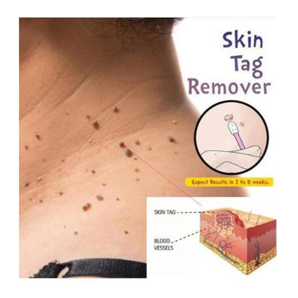 Крем для лечения бородавок и кожи удаления кожных ярлыков ног кукурузы