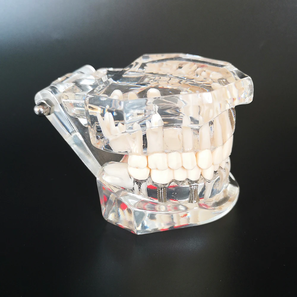 

Новая модель зубных имплантов, средство для реставрации зубов, обучение, изучение заболеваний медицины, товары