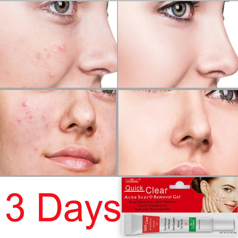 Эффективный крем для удаления акне 10 шт./лот лечение прыщей контроль жирности