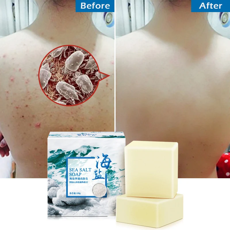 

3PCS Removal Pimple Pore Acne Treatment Sea Salt Soap Cleaner Moisturizing Goat Milk Soap Face Care Wash Basis Soap 100g