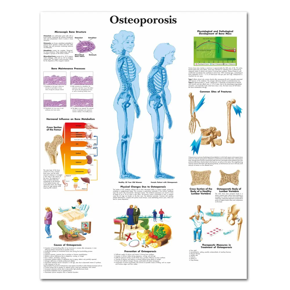 WANGART остеопороз диаграмма холст с печатью постера живопись настенные картины для