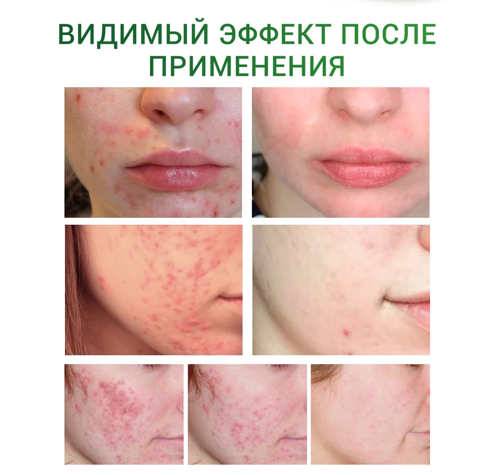 Breylee маска для лица крем для лица сыворотка для лица от прыщей лечение акне Сыворотка для ухода за кожей лица Маска Крем против акне крем отбеливающий крем маски для лица устройство для удаления прыщей инструменты