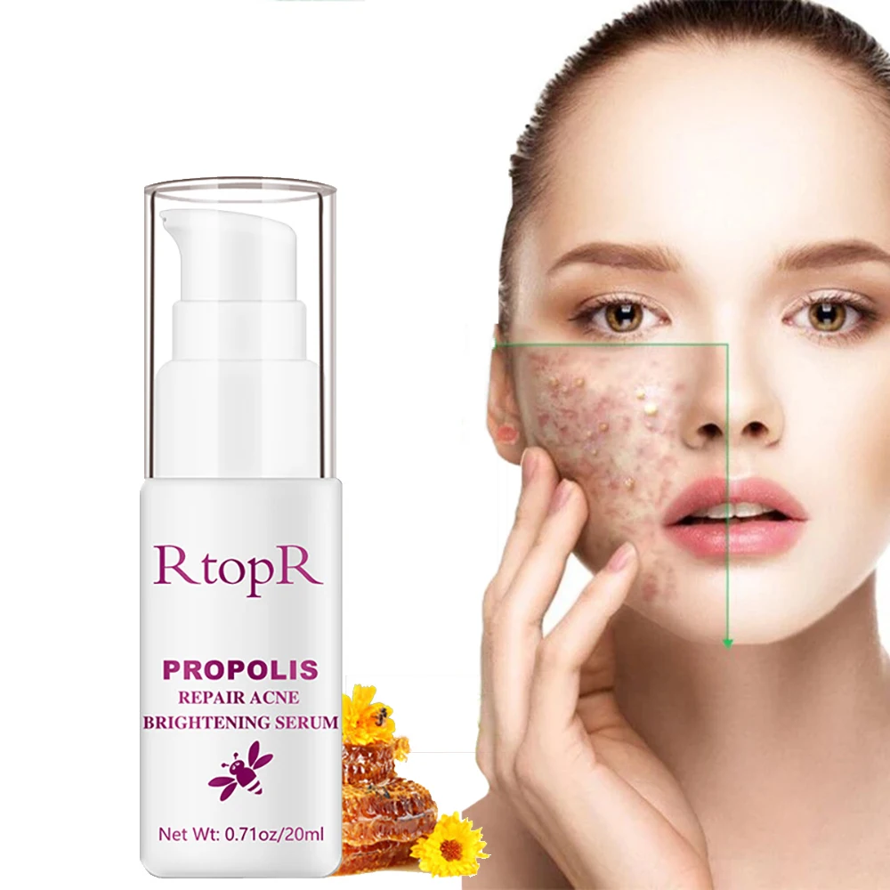 

Acne Treatment Propolis Essence Oil Control Eliminates Soothes Skin Acne Fade Acne Marks Shrink Pores Nourish Face Care 20ML