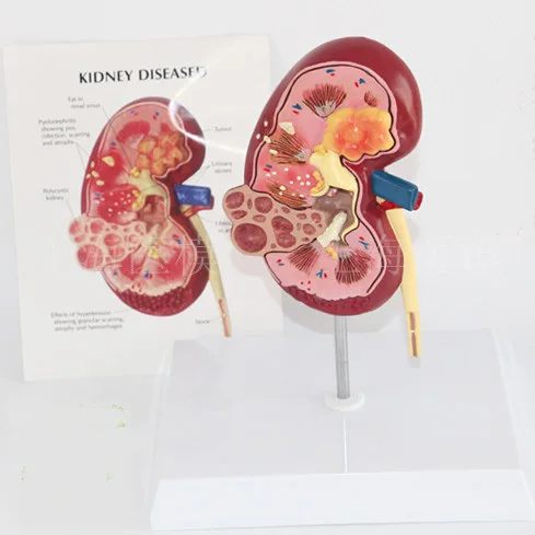 Модель почечной болезни урология модель почек nephron glomerular анатомии|Массажный мяч|