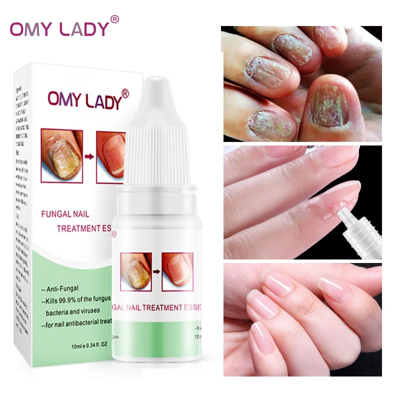 OMY LADY грибковый рельсовый ремонт эссенция Сыворотка для удаления грибка ногтей
