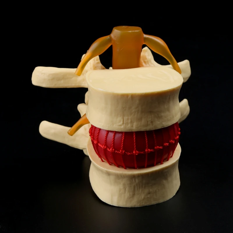Anatomical Spine Lumbar Disc Herniation Anatomy Medical Teaching Tool |