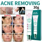 Крем для ухода за кожей лица и акне, 30 мл