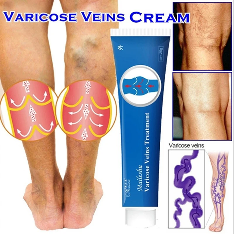 

20g Varicose Veins Treatment Cream Effective Cure Leg Acid Vasculitis Phlebitis Spider Veins Pain Relief Angiitis Ointment