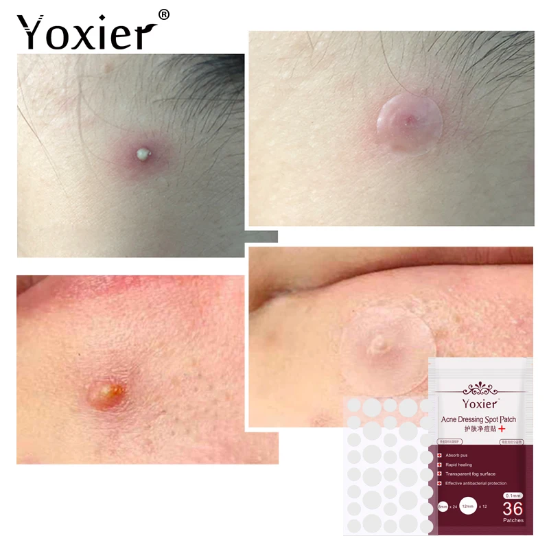 Yoxier 3pcs/lot Ance Pimple Patch Skin Care Waterproof Treatment Stickers Face Mask Remover Tool Blemish Spot Cream |