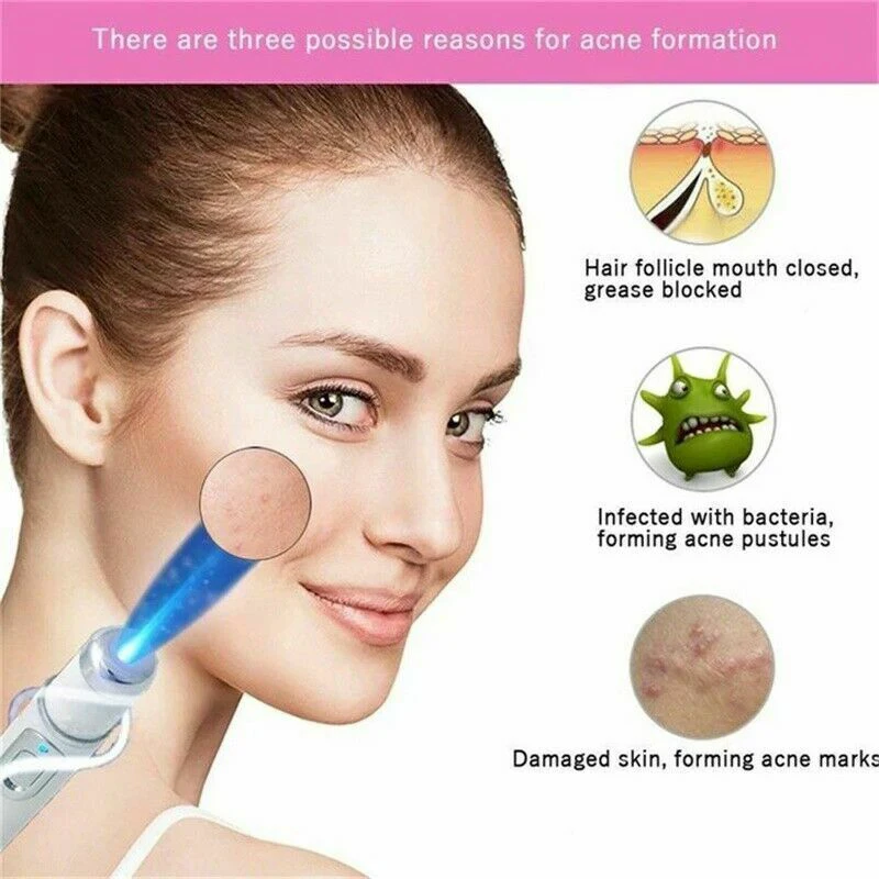 

Hot Portable Blue Light Remove Acne Pen Wrinkle Removal Skin Care Tool t6