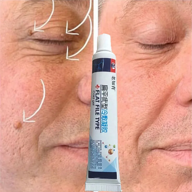 Удаление бородавок на коже удаление жидкости с кожи моли|Устройство для ухода за