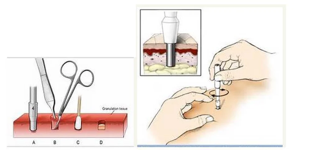 Микродермал как крепится схема