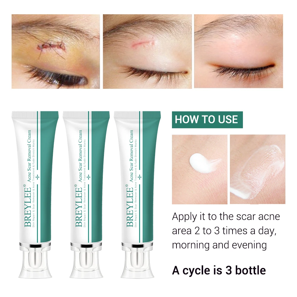 

BREYLEE Scar Removal Cream Face Cream Scar Stretchmarks Spots Remover Cream Skin Repair Acne Treatment Whitening Body Cream 30g