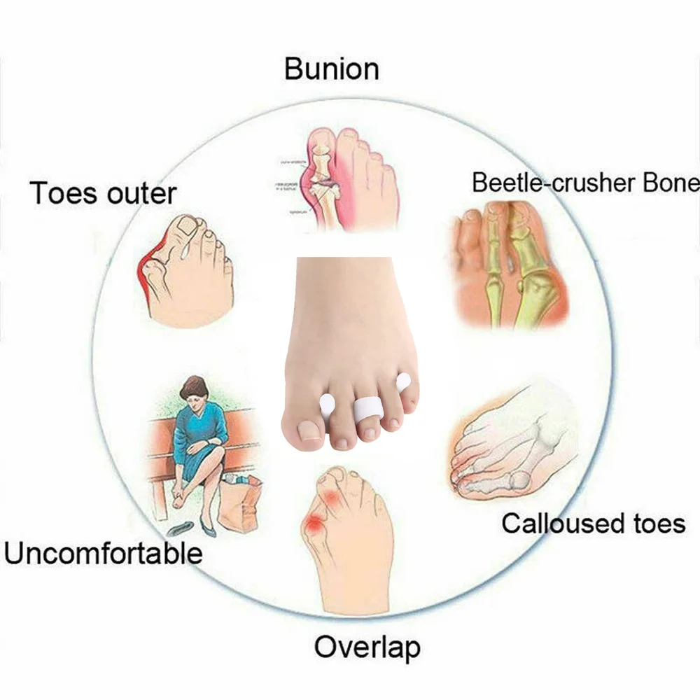 1Pair of Toes Bunion Corrector Hallux Valgus Corrector Day Night Toes Correction Feet Care Cylinder shape