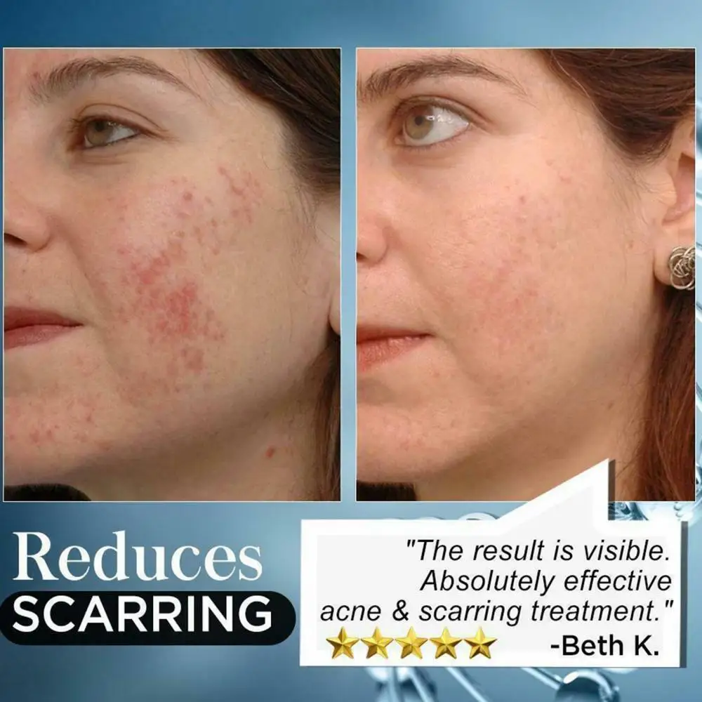 

Cream Skin Care Boy Girl Student Anti Acne Scar Removal Face Treatment Repair