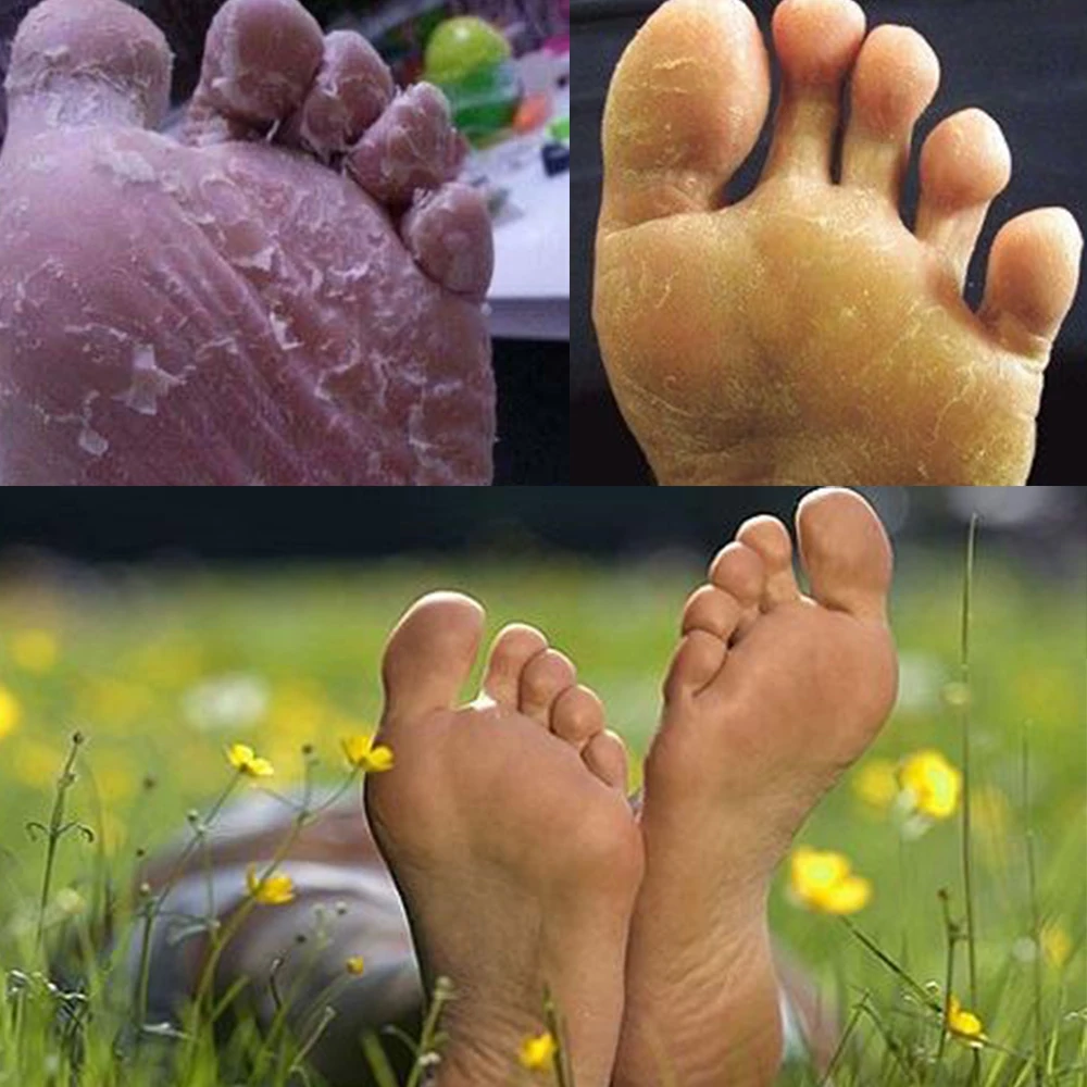 

New Fungal Nail Treatment Detox Foot Soak Long-Term Relief Athlete's Foot Skin Cracking Psoriasis Peeling Beriberi