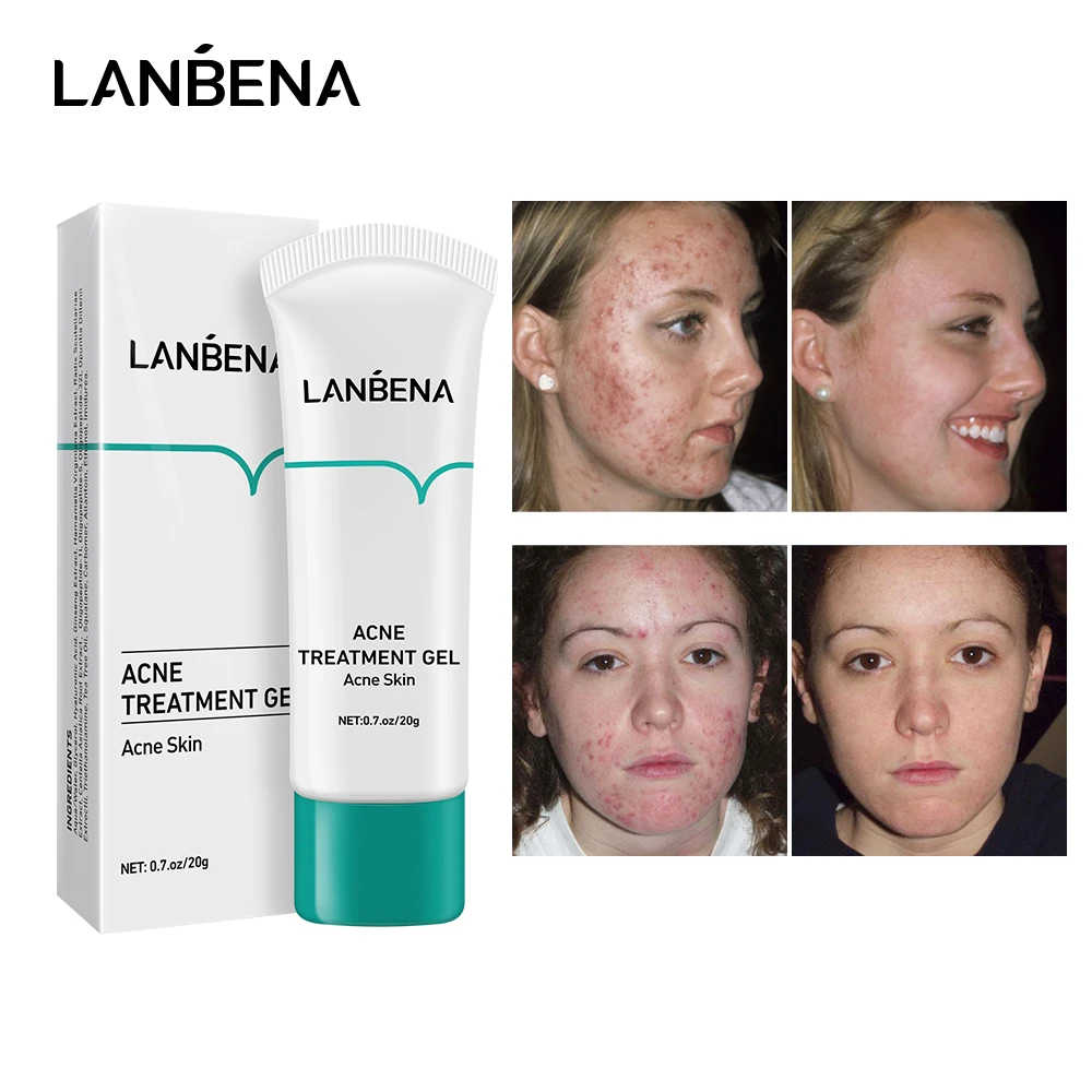 

LANBENA Acne Treatment Cream Remove Blackheads Pimples Gel Face Clean Effective Fade Marks Scars Refreshing Repair Damaged Skin