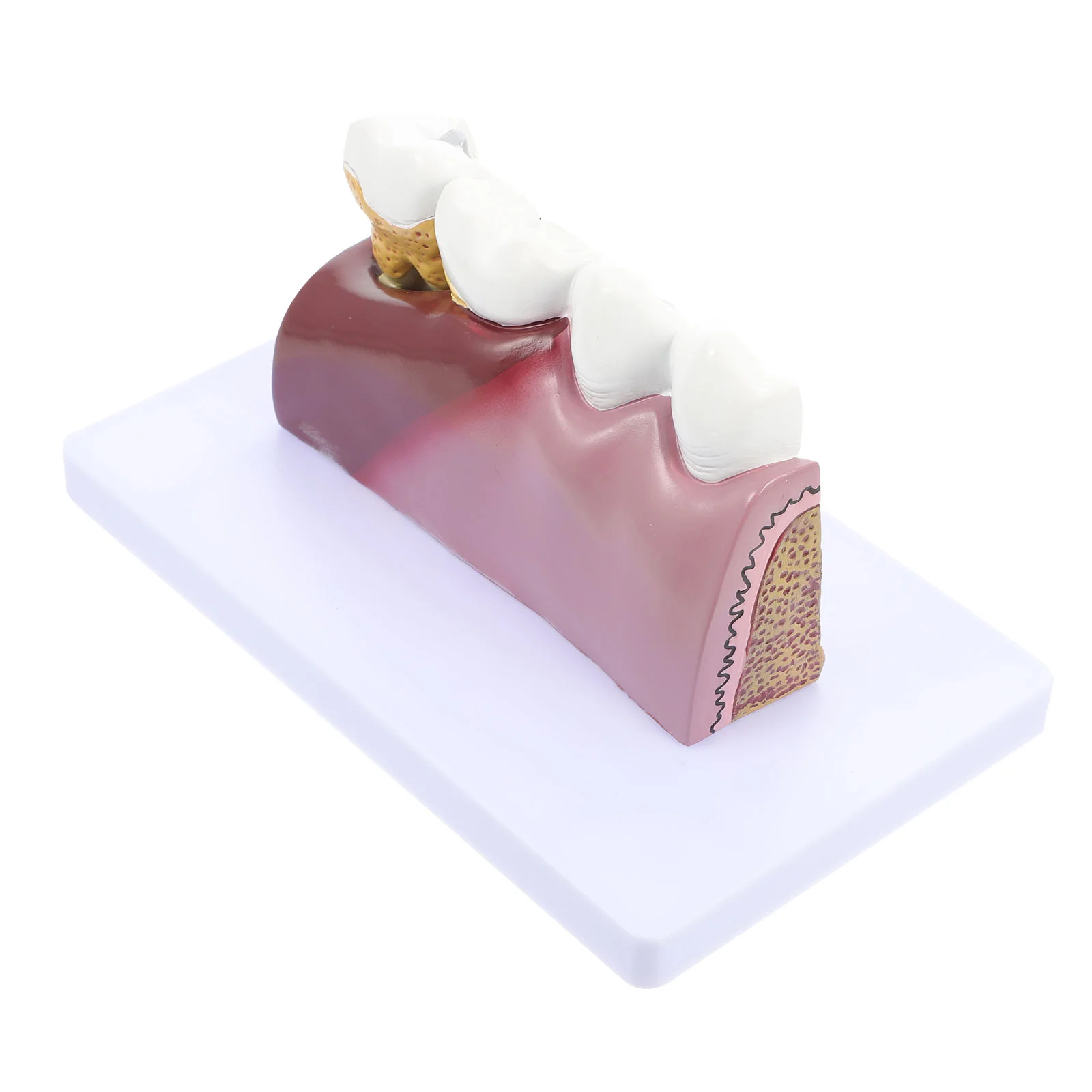 

1 Pc Caries Tooth Model Practical Teeth Model Anatomical Teeth Model