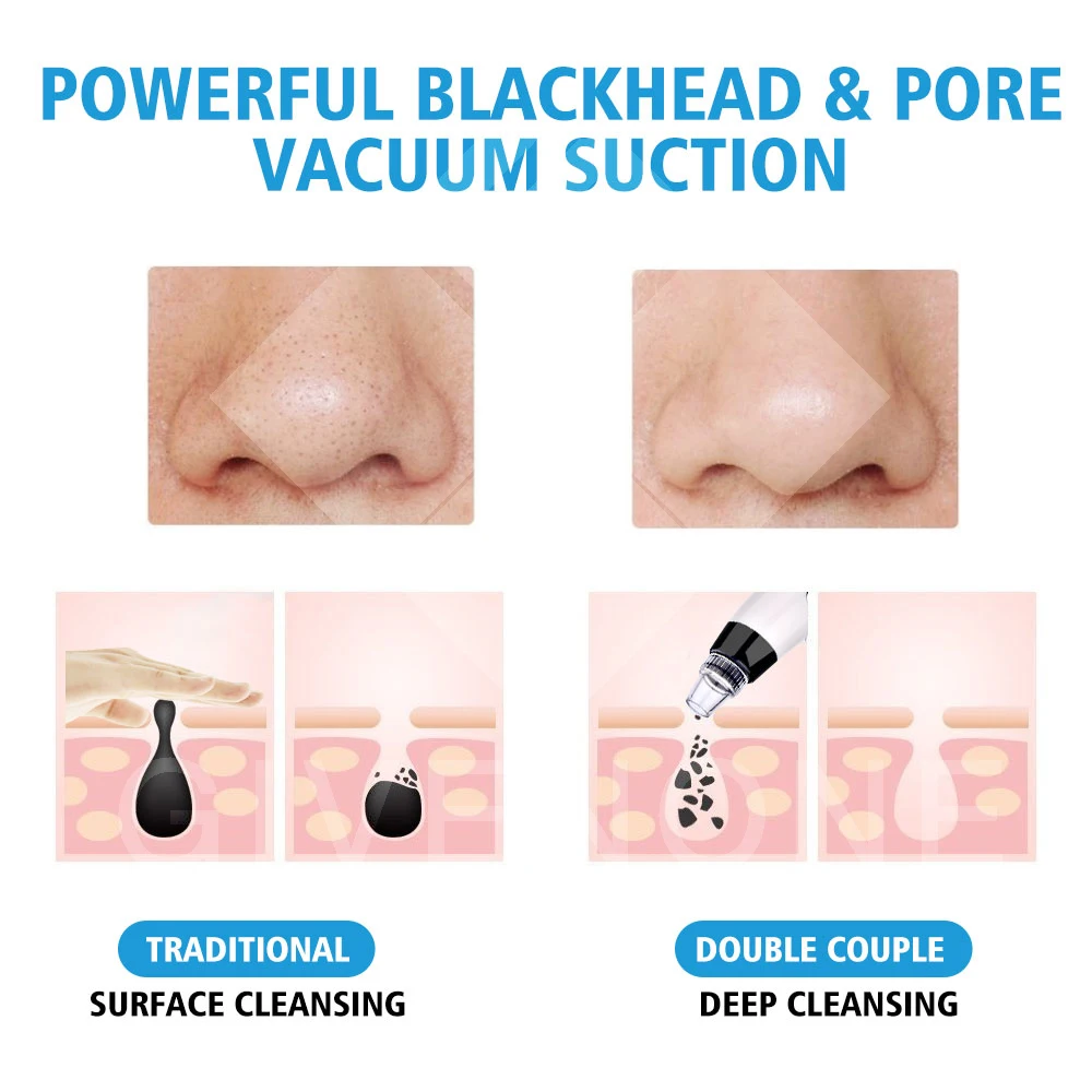 

Vacuum Blackhead Nose Pore Cleaner Acne PimpleRemoval Electronic Devices Low Noise Clean Skin Tool With 5 Suction Heads