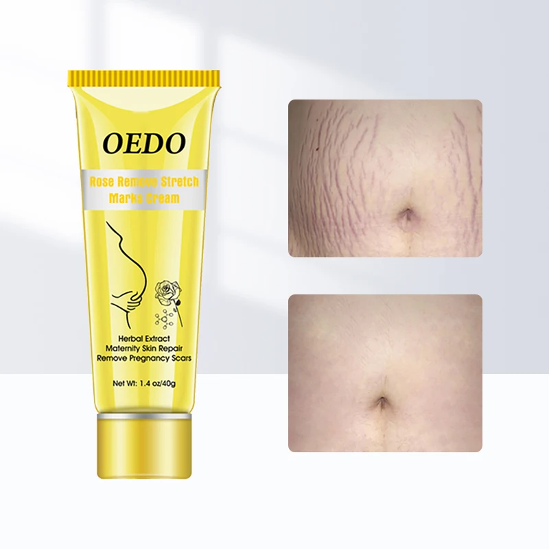 

Pregnancy Scar Removal Cream Smooth Skin Stretch Mark Remove Maternal Skin Repair Body Postpartum Scar Care Firming and Brighten