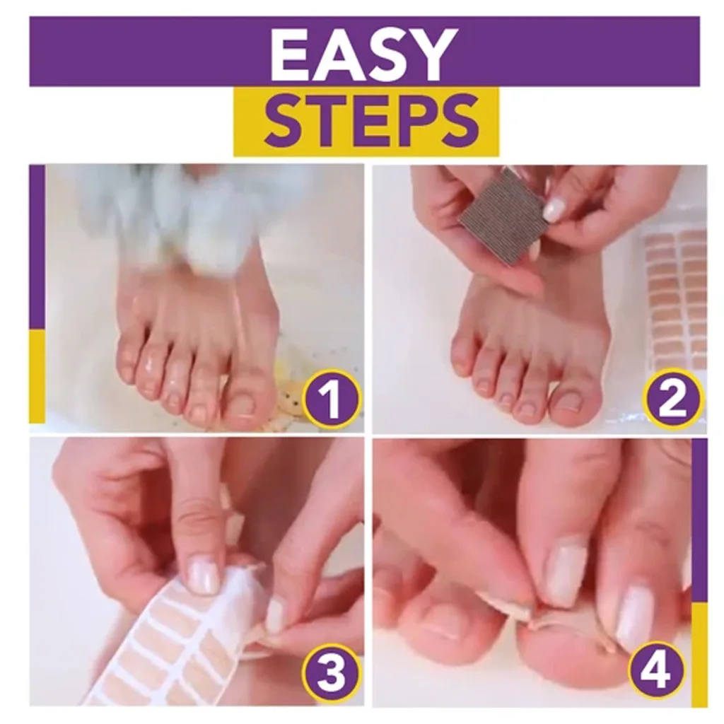 5pcs Glue Free Ingrown Toenail Patch Set Correction Pedicure Tools Inlay Nail Corrector Stickers Foot Care |