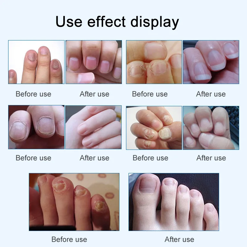 

15ml Nail Fungal Treatment Onychomycosis Removal Anti Fungus Nails Care Repair Liquid A7