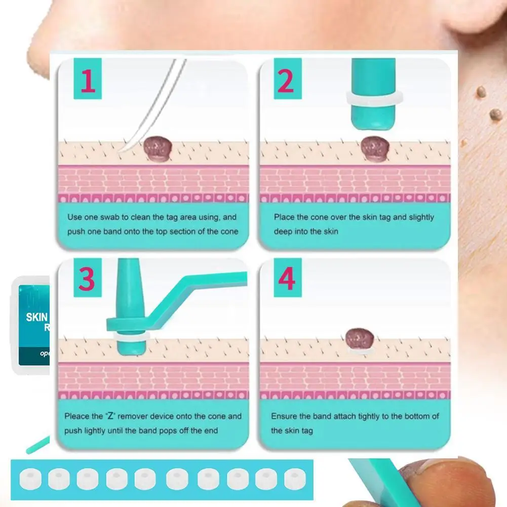 

1set Skin Tag Kill Skin Mole Wart Remover With Cleansing Swabs Face Wart Mole Removal Tools Tag Skin Care Adult Micro Kit X9Y9