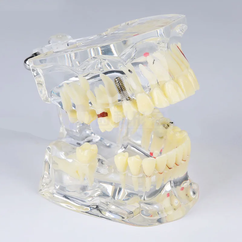 Стоматологическая прозрачная взрослая патологическая Модель дисплея зубов