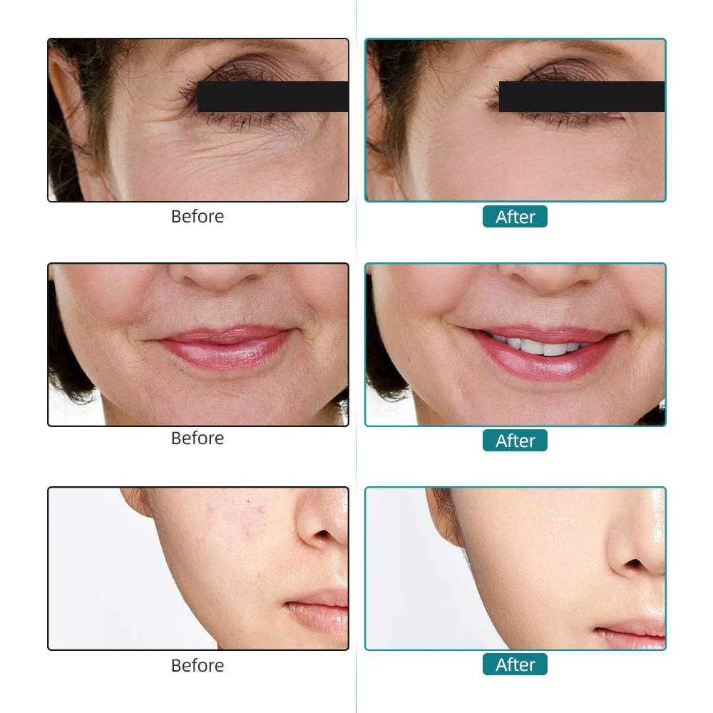 

Facial Ultrasound CO2 Oxygen RF Beauty Machine Skin Rejuvenation Brightening Tripollar RF Face Lifting Shrink Pores Anti Wrinkle